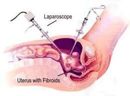 Fibroid Uterus Removed – Case by Dr. Sangeeta Antaratani | Gynaecologist in Hubli