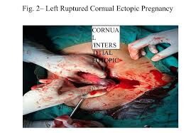 A rare case cornual ectopic – A Case by Dr. Sangeeta Antaratani