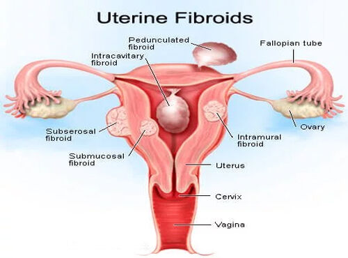 A Rare Case of Fibroid Polyp with Chronic Uterine Inversion – Dr. Sangeeta Antaratani