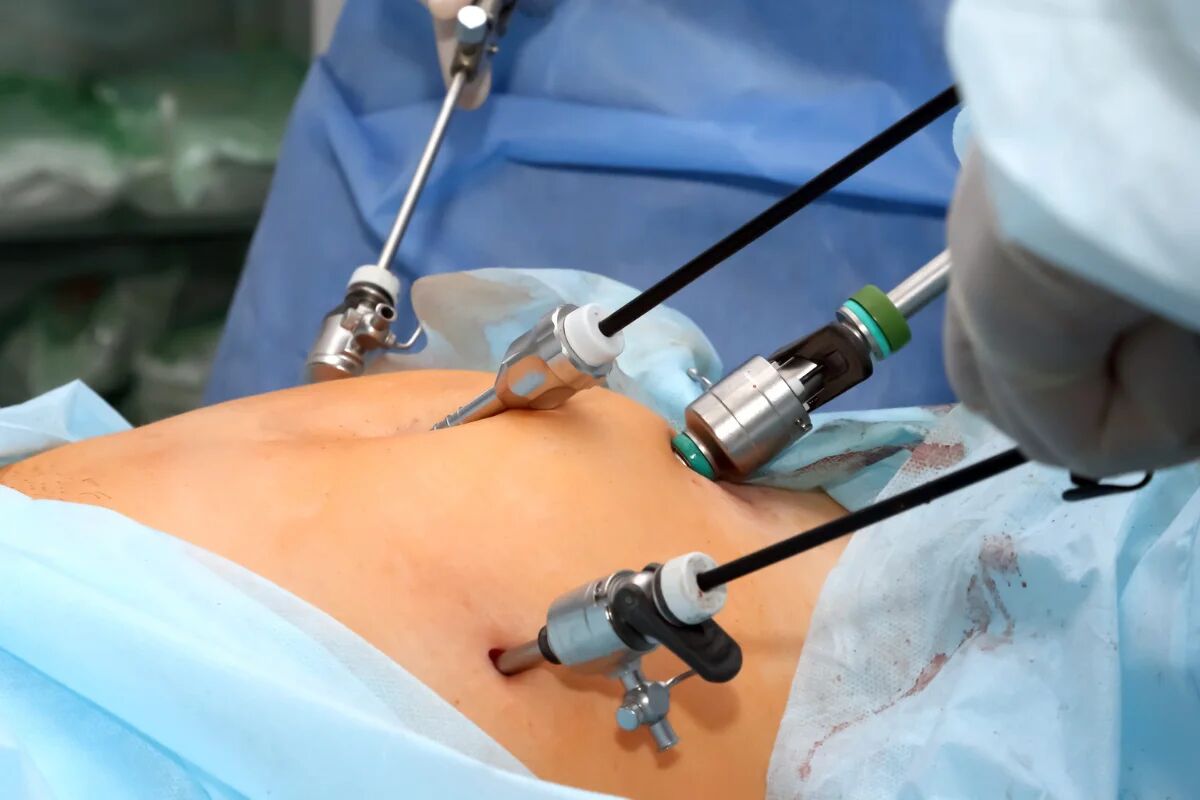 Successful Total Laparoscopic Hysterectomy for Huge Fibroid Uterus at Sushruta Multispecialty Hospital, Hubli